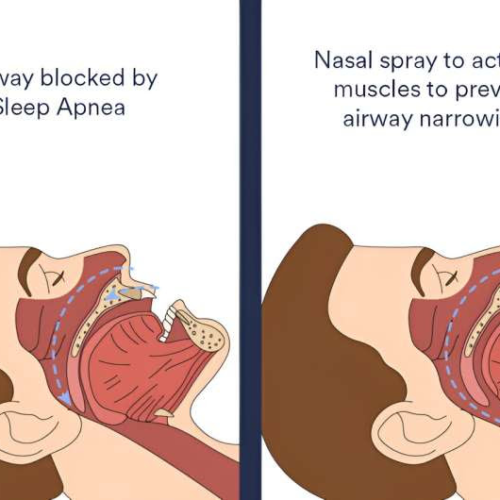 New nasal spray may reduce severity of sleep apnea, researchers find