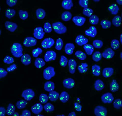 Protein discovery sparks treatment hope for aggressive cancer
