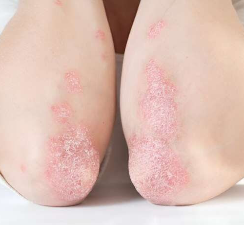 Trials shows bimekizumab response durable at four years for moderate-to-severe psoriasis