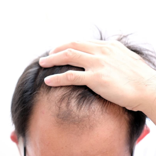 Hair-loss breakthrough found in keratin microspheres