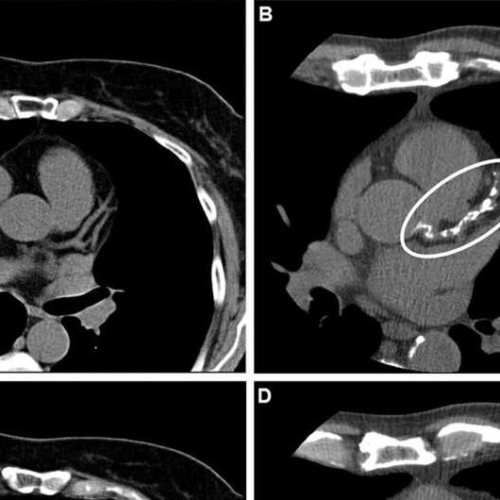 Study finds coronary artery calcium score is predictive of heart attacks, strokes