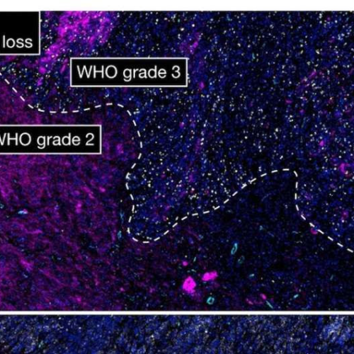 New mechanisms underlying tumor variety in brain cancers discovered