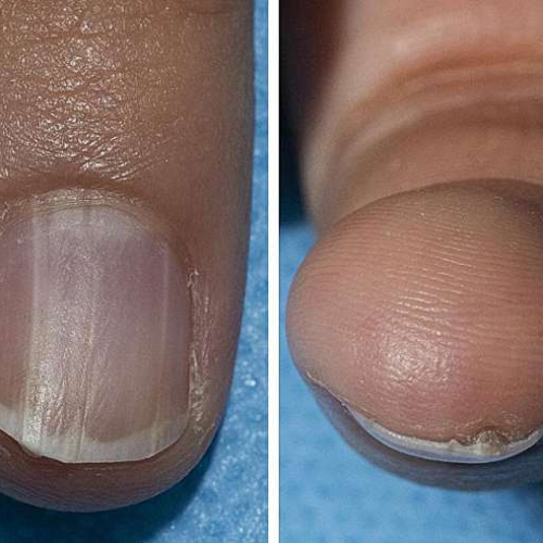 Benign nail condition linked to rare syndrome that greatly increases cancer risk