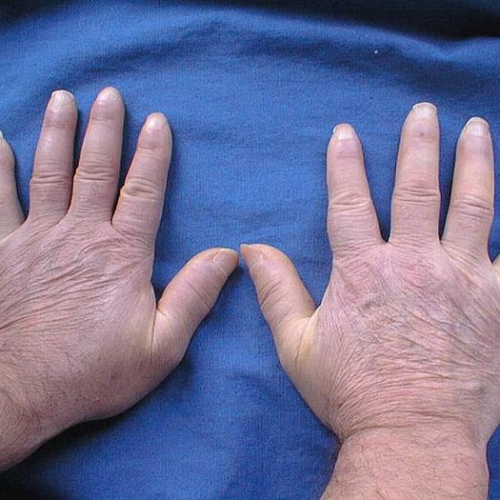Antioxidant Dietary Supplement “Twendee X®” can help counter systemic sclerosis