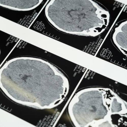 Do You Have A Mild Concussion? New AI Might Aid Diagnosis