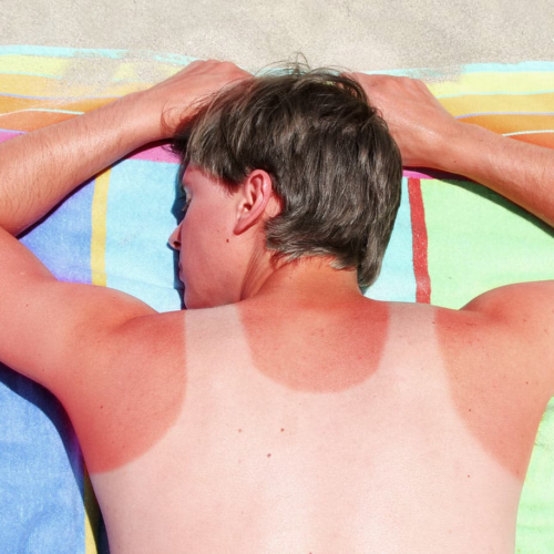 WHAT ACTUALLY HAPPENS WHEN YOU GET A SUNBURN?