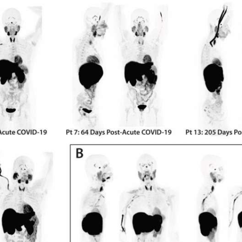 Long COVID uncharacteristic immune cell activity and SARS-CoV-2 RNA found in the gut two years after infection