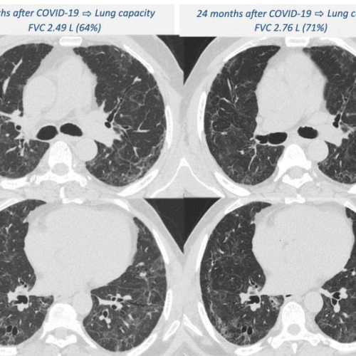 Lung complications can worsen two years after hospitalization for severe COVID-19