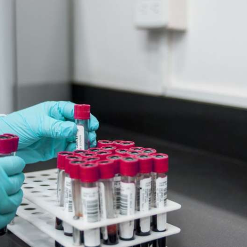 Blood test to detect alpha-synuclein protein could revolutionize Parkinson’s disease diagnostics