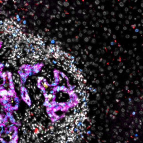 Researchers uncover how colorectal cancer cells colonize the liver