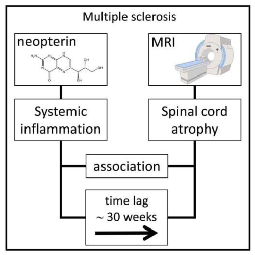 Multiple sclerosis progression linked to immune response outside the brain