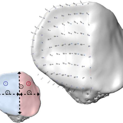 Link found between kneecap shape and debilitating joint disease