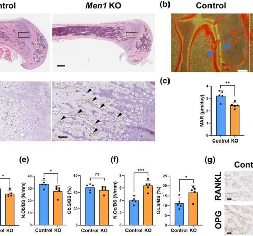 New gene linked to osteoporosis identified