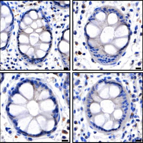 Robotic methods help put brakes on inflammatory diseases