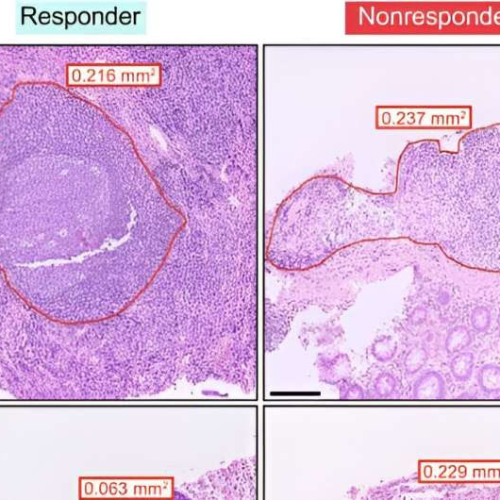 Front-line drug for ulcerative colitis found to have additional mechanism of action that until now remained elusive