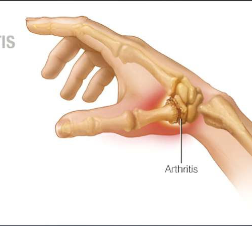 Video: Reducing thumb arthritis pain