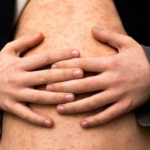 US measles cases are already triple those of last year