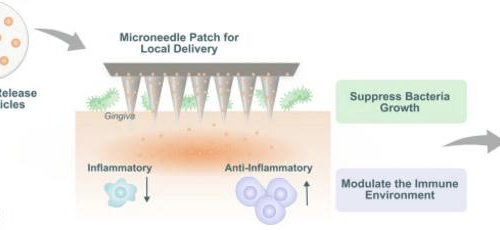 Dissolvable microneedle patch enables local delivery of immunomodulatory microparticles containing bifunctional molecules for periodontal tissue regeneration