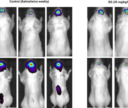 Drug shows promise for treating brain tumors resulting from breast cancer, trial reports