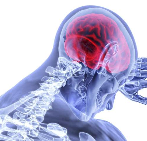 Brain biomarker in blood sample predicts stroke, researchers demonstrate