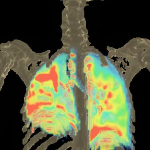 Researchers report potential new treatment regimens for multidrug-resistant TB meningitis