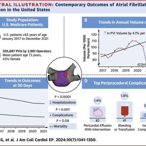 Pulmonary vein isolation is safe and effective treatment of irregular heartbeat