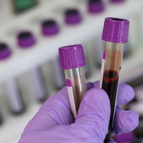 Q&A: Expert explains the reliability of Alzheimer’s blood tests