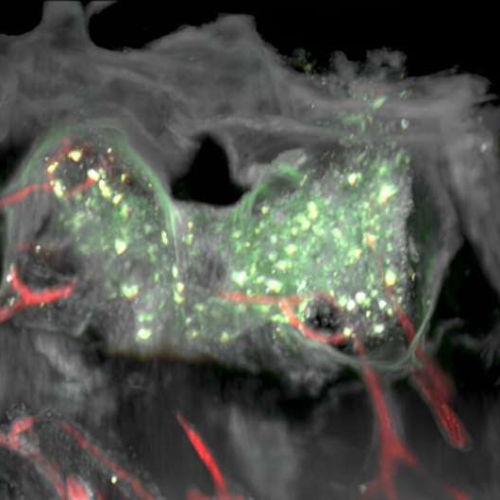 Surprising finding in glioblastomas: Nearby bone marrow niches may serve as anti-tumor defense bases