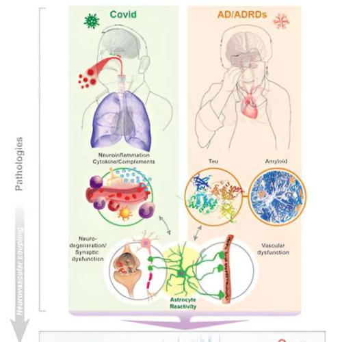 Alzheimer’s-like brain changes found in long COVID patients