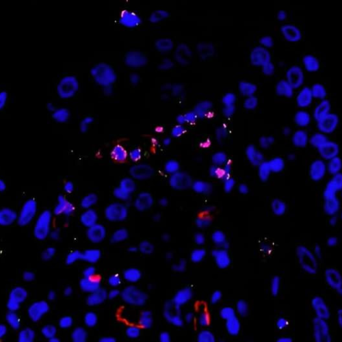 Severe COVID-19 can involve either exacerbated lung inflammation or high viral replication, study finds