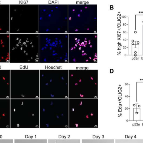 New study uncovers key mechanisms responsible for the transformation of adult progenitors into brain tumors