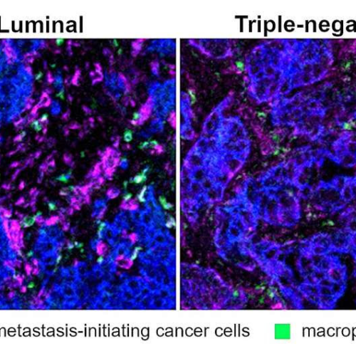 Scientists identify potential new immune system target to head off the spread of breast cancer cells