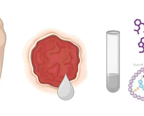 Insulin and metformin combo aids diabetic foot ulcer healing, new study finds