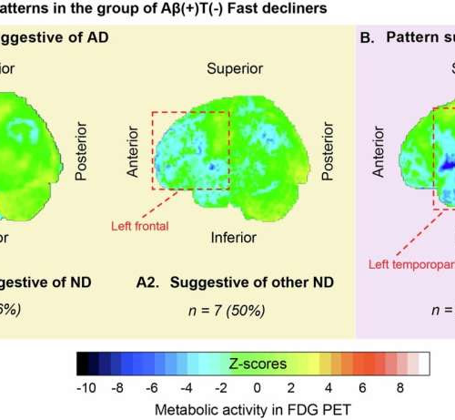 Alzheimer’s study reveals critical differences in memory loss progression based on the presence of specific proteins