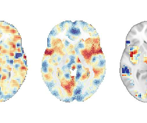 Brain scans reveal that mindfulness meditation for pain is not a placebo