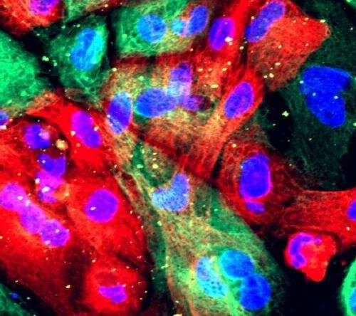 Protein NSD2 found to drive early prostate cancer development