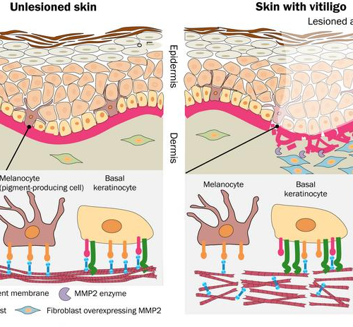 Loss of skin’s pigment-producing cells could be related to basement membrane disruption