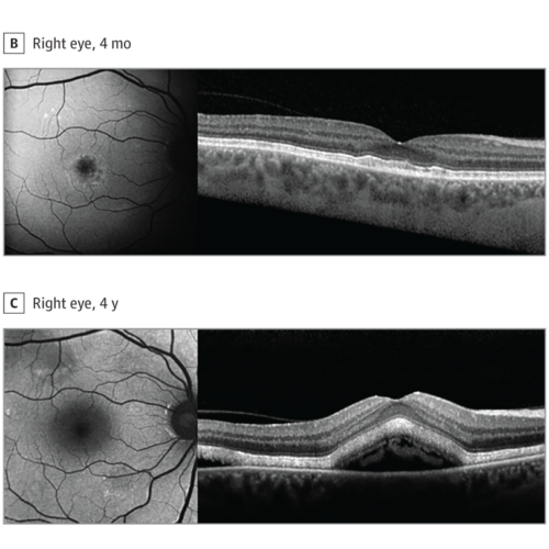 Retinopathy associated with hair dye