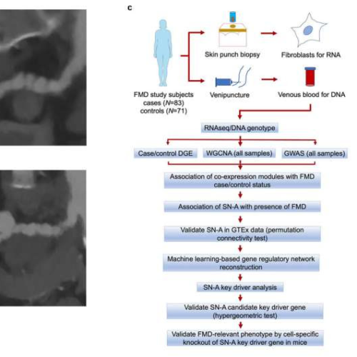 Scientists discover potential cause of an enigmatic vascular disease primarily impacting women