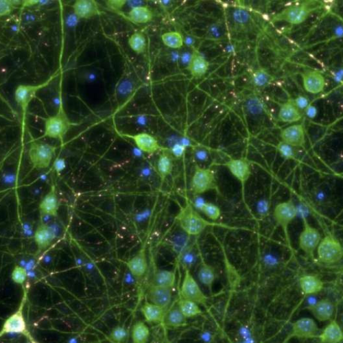 New therapy that targets and destroys tau tangles: A promising Alzheimer’s disease treatment