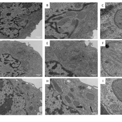 Team discovers role of ferroptosis in combating breast cancer resistance