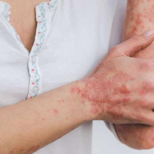 Signs of arthritis found in one in four psoriasis patients, new study reveals