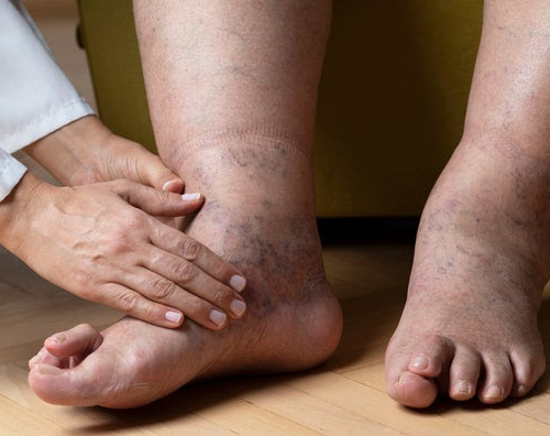 What Are Common Foot Problems in Older Adults, and How Do You Treat Them?