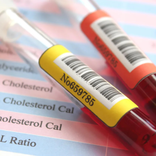 Got high cholesterol? Here are 5 ways to manage it.