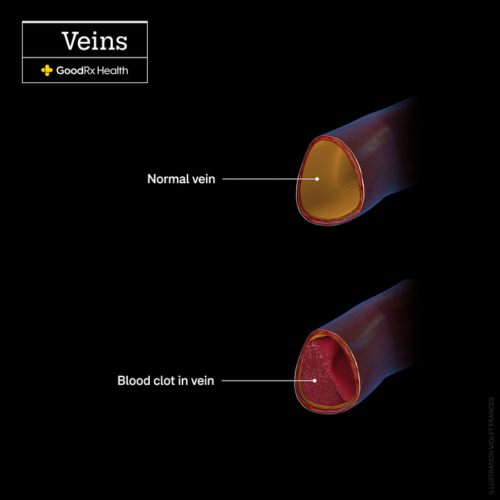 What Does a Blood Clot Feel Like?