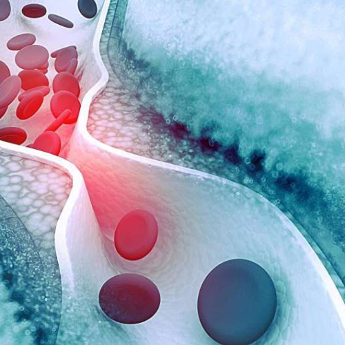 High insulin levels genetically linked to lower lipoprotein(a)