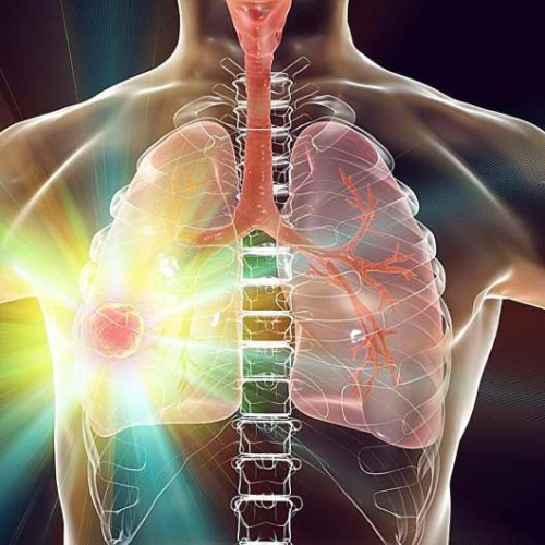 Lung complications + rheumatoid arthritis increase risk for lung cancer