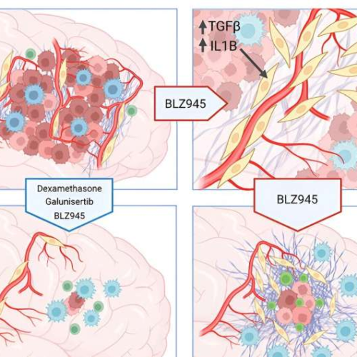 How the scars of demolished brain tumors seed relapse