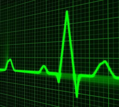 Atrial fibrillation estimated to be three times more common than previously thought