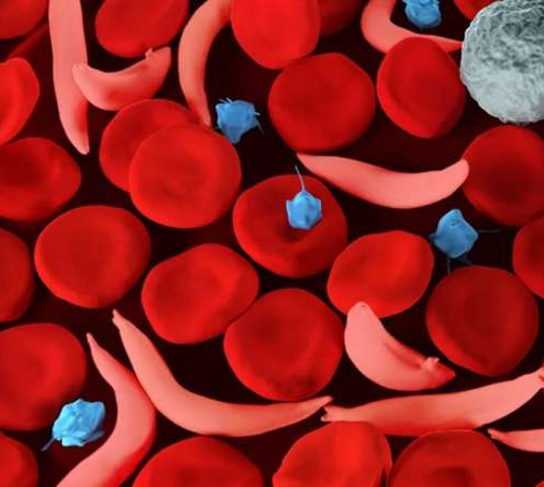 Sickle cell trait is prevalent among diverse human populations, study finds